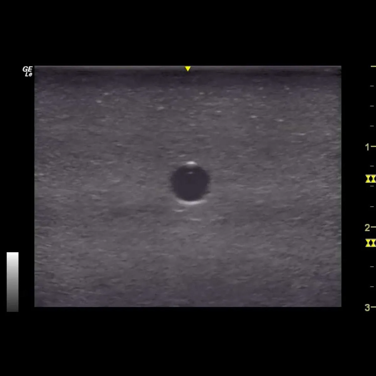 HM2.0 -  Re-Moldable 2 Vessel Ultrasound Training Model