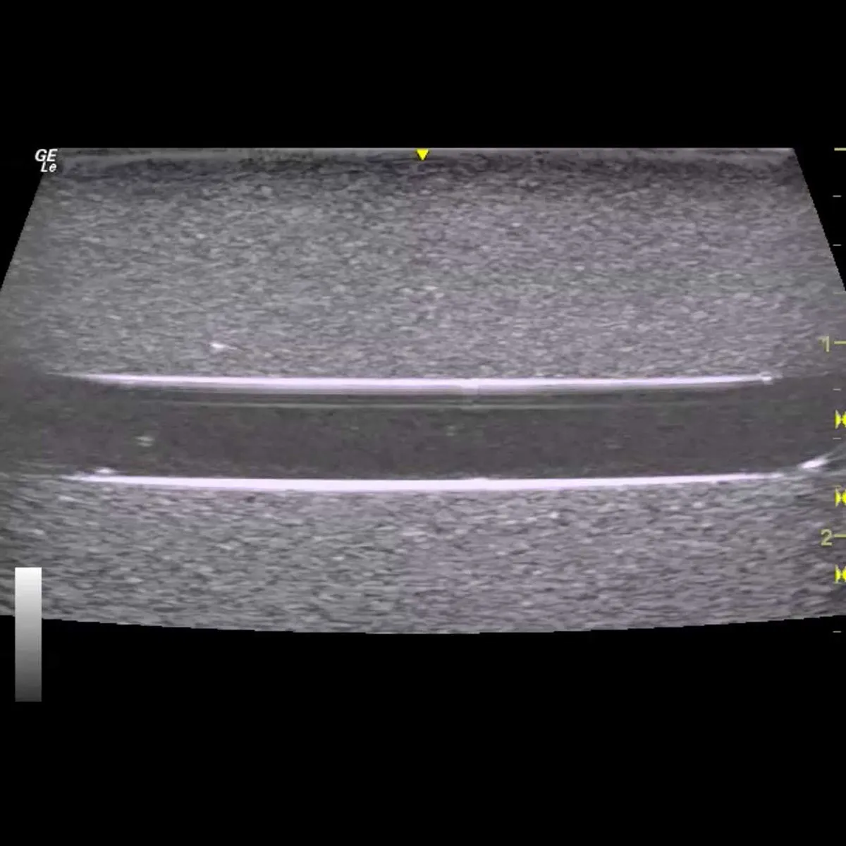 HM2.0 -  Re-Moldable 2 Vessel Ultrasound Training Model