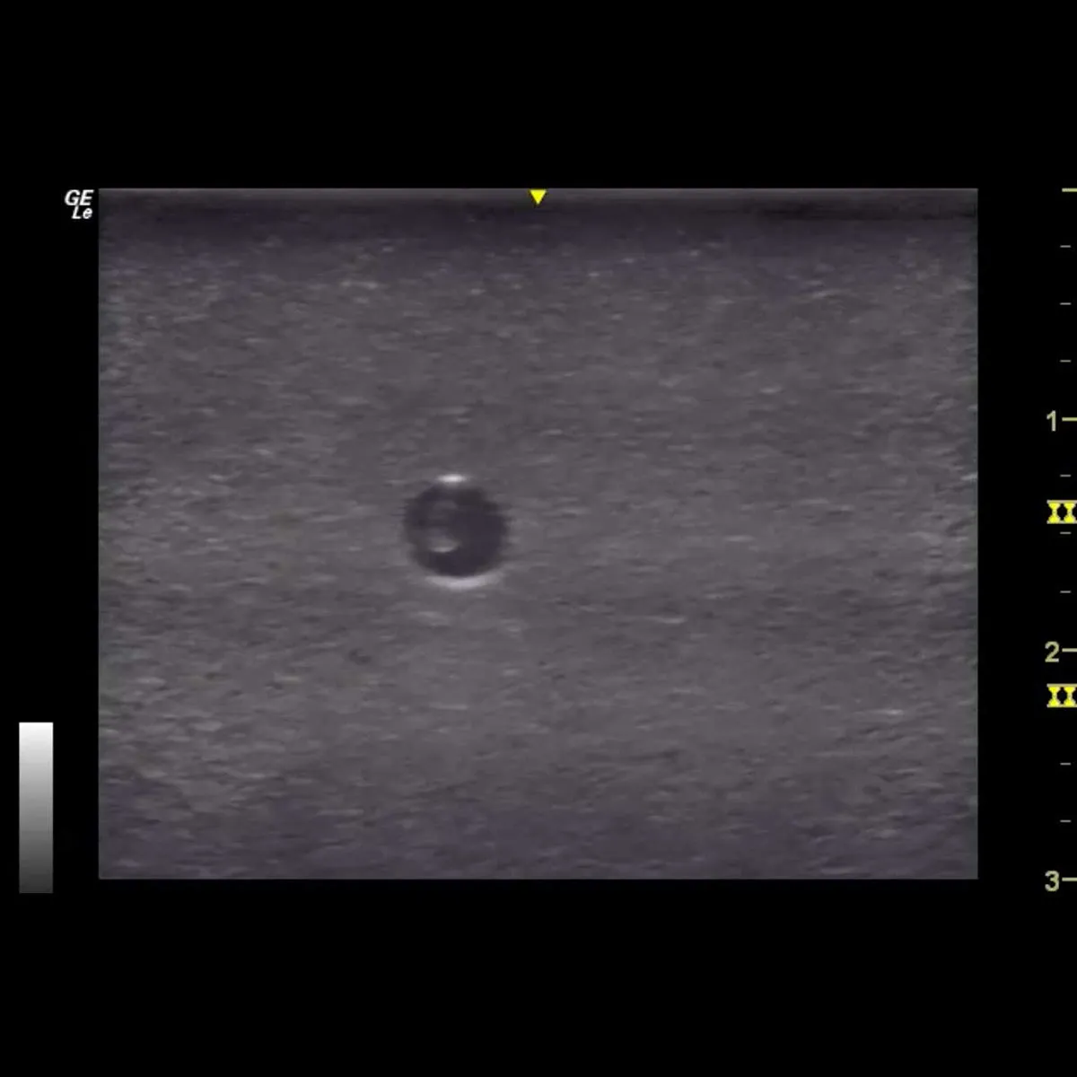 HM2.0 -  Re-Moldable 2 Vessel Ultrasound Training Model