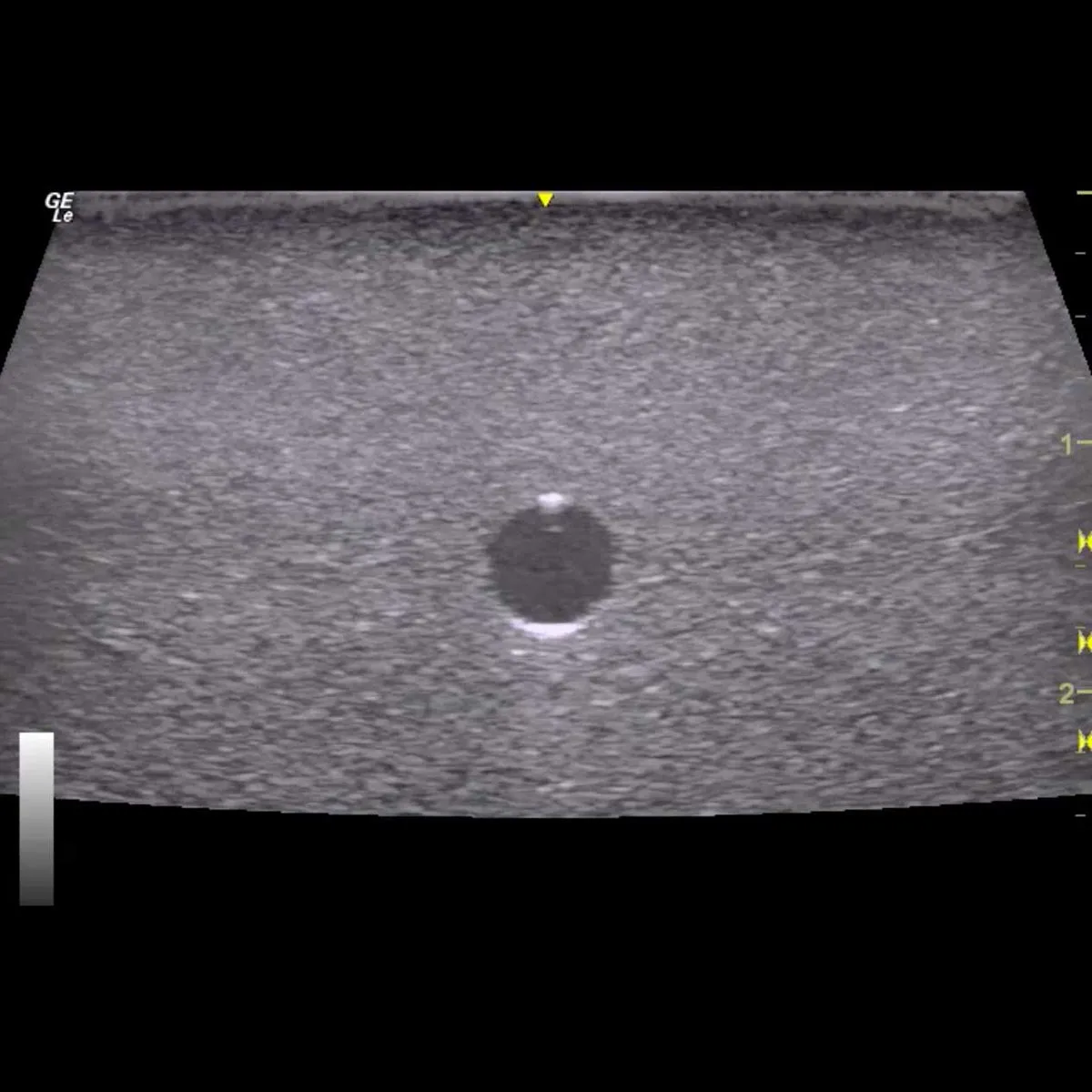 HM2.0 -  Re-Moldable 2 Vessel Ultrasound Training Model