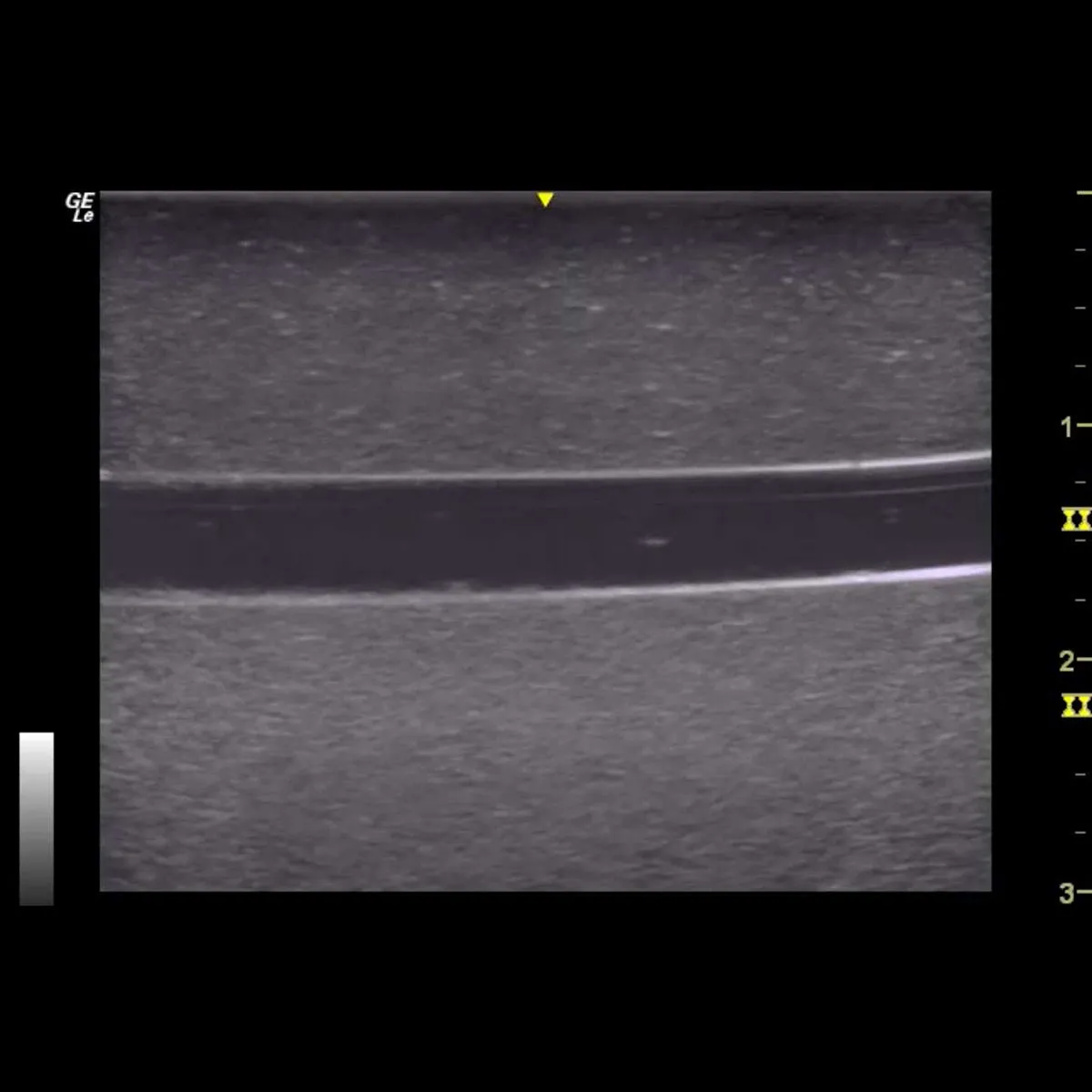 HM2.0 -  Re-Moldable 2 Vessel Ultrasound Training Model