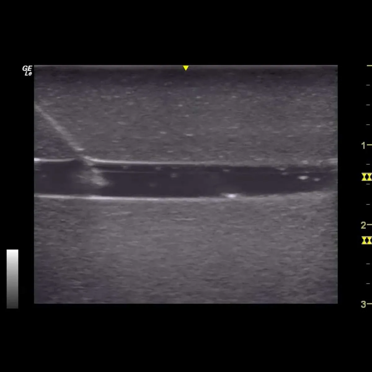 HM2.0 -  Re-Moldable 2 Vessel Ultrasound Training Model