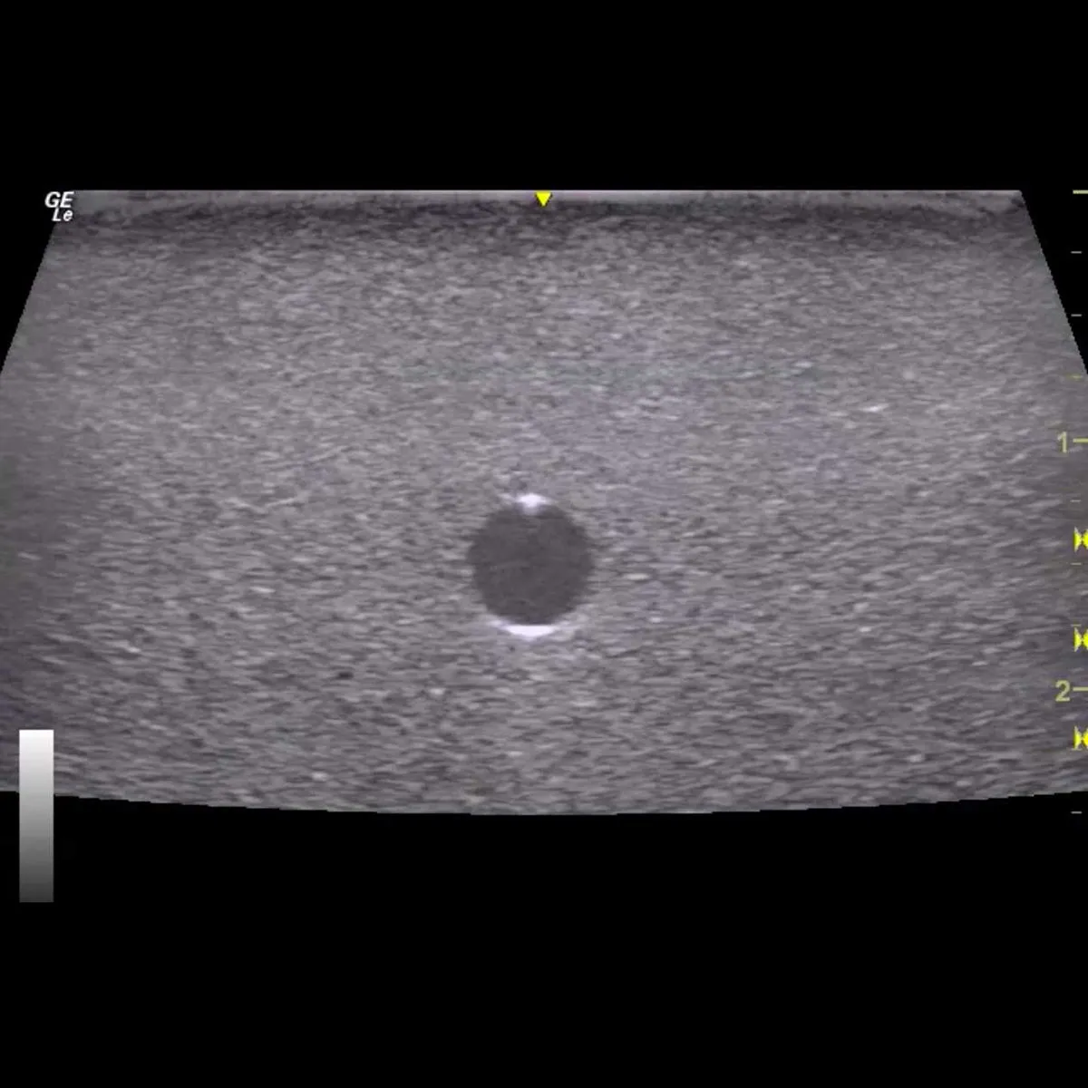 HM2.0 -  Re-Moldable 2 Vessel Ultrasound Training Model
