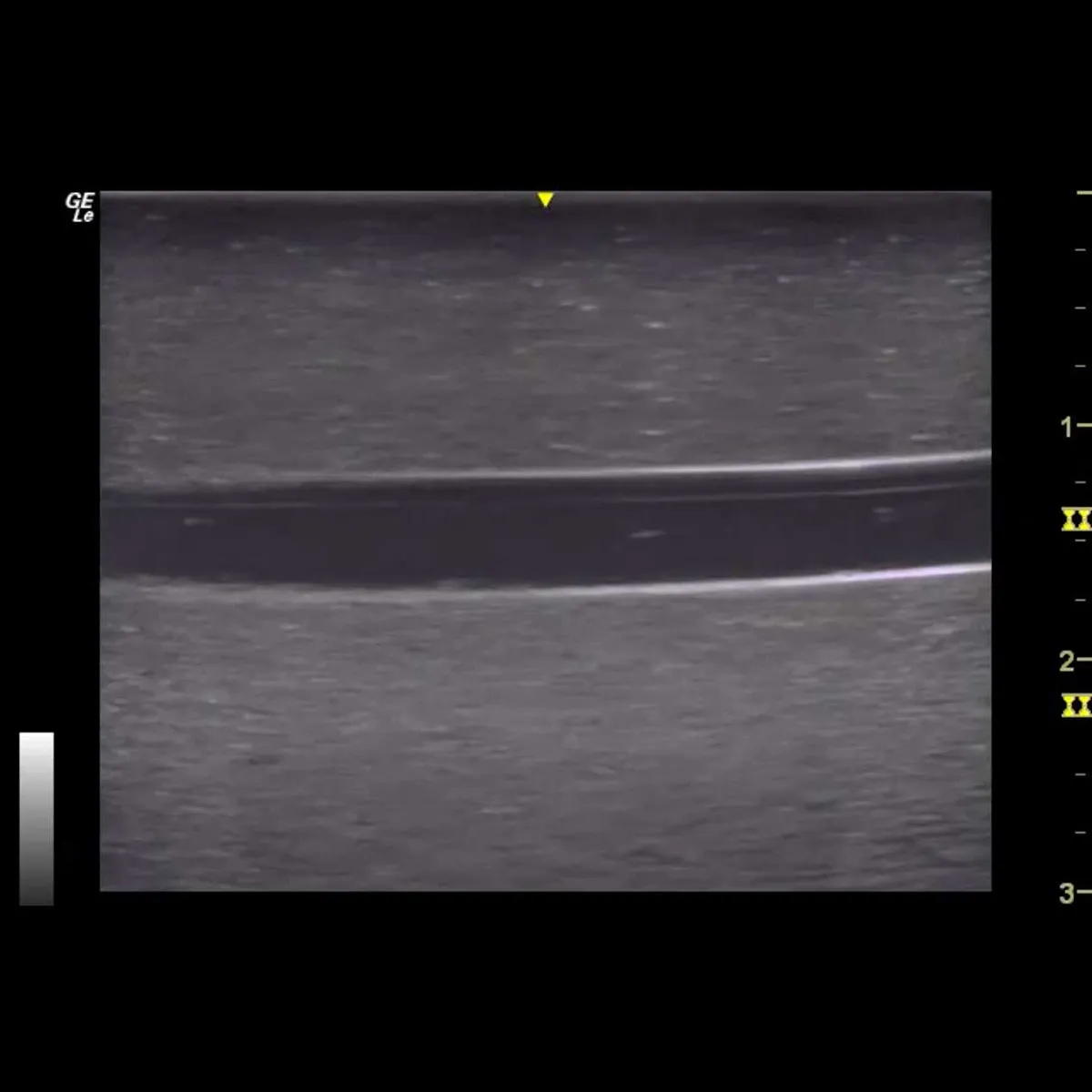 HM2.0 -  Re-Moldable 2 Vessel Ultrasound Training Model
